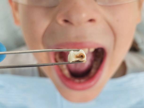 Best Emergency Dental Care for Broken or Chipped Teeth in Chamberlain, SD